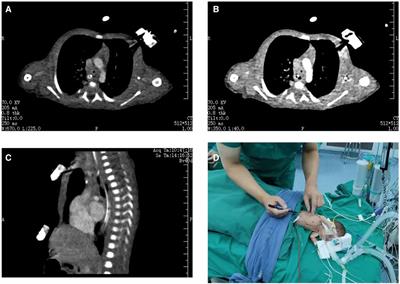 Case Report: ECMO-assisted tracheal reconstruction in a 30-week-gestation preterm infant with tracheal stenosis